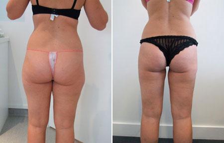 Thighs liposuction
