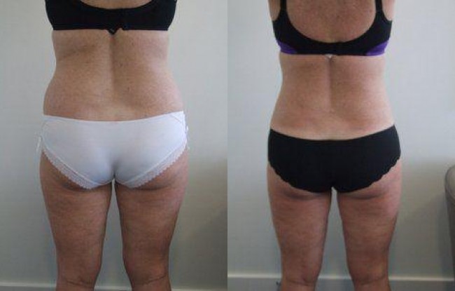The waist area responds particularly well to liposculpture. Once treated it reveals a more feminine and youthful shape