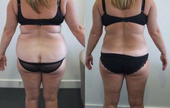 Liposuction performed to the waist, hips, underbra and inner thighs area resulting in a much more youthful contour