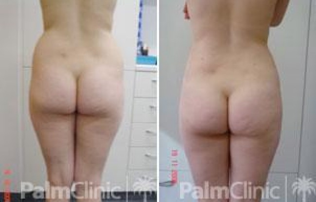 Treatment of the waist area is often combined with treatment of the abdomen and/or the hips with dramatic improvements in shape