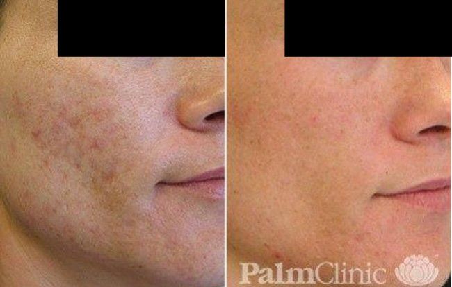Fraxel Laser has significantly improved acne scarring.